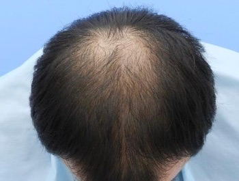 薄毛治療 発毛症例 35歳/O型/初診時