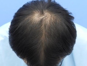 薄毛治療 発毛症例 35歳/O型/7ヶ月後