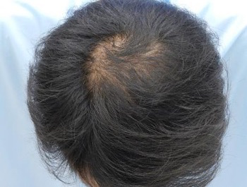 薄毛治療 発毛症例 33歳/O型/5ヶ月後
