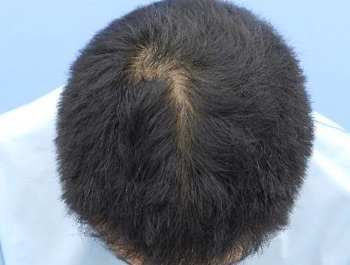 薄毛治療 発毛症例 47歳/O型/6ヶ月後