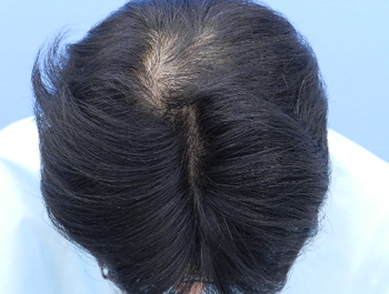薄毛治療 発毛症例 38歳/O型/7ヶ月後