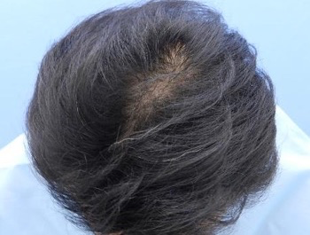 薄毛治療 発毛症例 36歳/O型/6ヶ月後