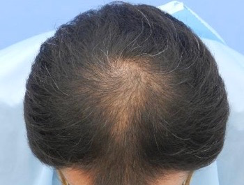 AGA治療例:39歳/MO型/薄毛歴15年/会社員/3ヶ月後