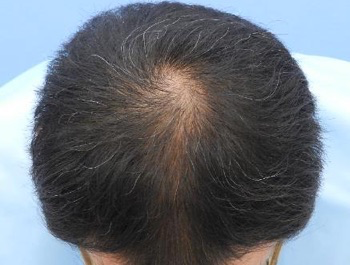 薄毛治療 発毛症例 39歳/MO型/5ヶ月後