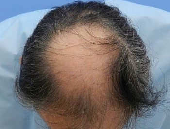 薄毛治療 発毛症例 65歳/MO型/初診時