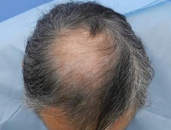 薄毛治療 発毛症例 65歳/MO型/6ヶ月後
