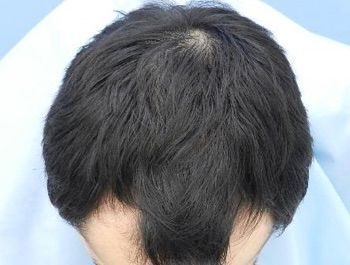 薄毛治療 発毛症例 25歳/O型/6ヶ月後