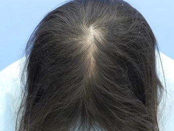 薄毛治療 発毛症例 25歳/頭頂部/7ヶ月後