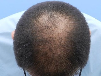 薄毛治療 発毛症例 44歳/MO型/5ヶ月後