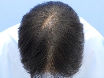 薄毛治療 発毛症例 48歳/O型/初診時