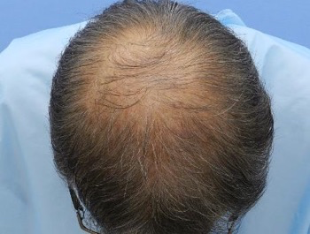 薄毛治療 発毛症例 64歳/O型/初診時