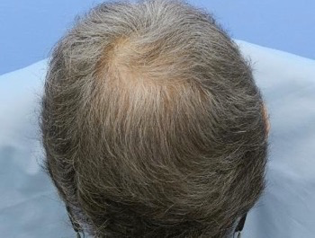 薄毛治療 発毛症例 64歳/O型/5ヶ月後