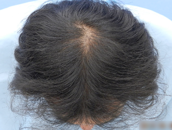薄毛治療 発毛症例 38歳/O型/初診時
