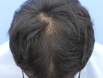 薄毛治療 発毛症例 24歳/MO型/8ヶ月後