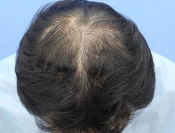 薄毛治療 発毛症例 45歳/O型/初診時