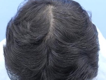 薄毛治療 発毛症例 45歳/O型/6ヶ月後