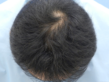 薄毛治療 発毛症例 49歳/O型/7ヶ月後