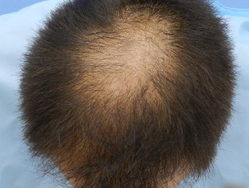 薄毛治療 発毛症例 56歳/O型/初診時