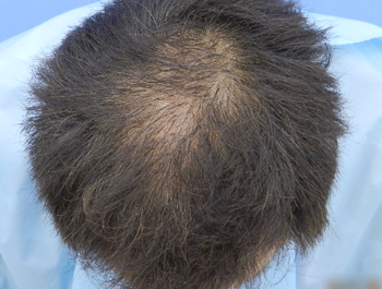 薄毛治療 発毛症例 56歳/O型/9ヶ月後