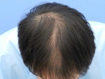 薄毛治療 発毛症例 34歳/MO型/初診時