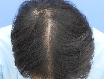 薄毛治療 発毛症例 34歳/MO型/8ヶ月後