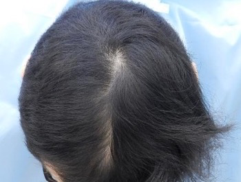 薄毛治療 発毛症例 36歳/MO型/8ヶ月後