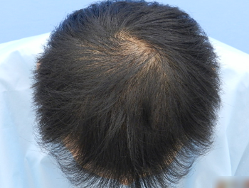 薄毛治療 発毛症例 43歳/O型/初診時