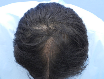 薄毛治療 発毛症例 38歳/MO型/12ヶ月後
