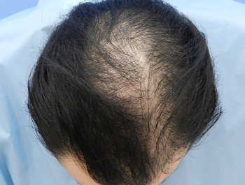 薄毛治療 発毛症例 28歳/O型/初診時
