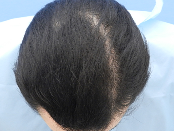 薄毛治療 発毛症例 28歳/O型/6ヶ月後