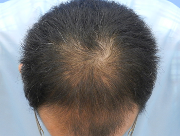 薄毛治療 発毛症例 36歳/MO型/9ヶ月後
