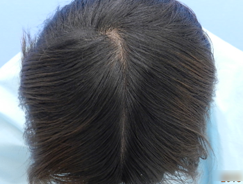 AGA治療例:27歳/O型/薄毛歴1年/会社員/3ヶ月後