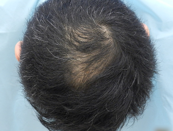 薄毛治療 発毛症例 49歳/O型/6ヶ月後