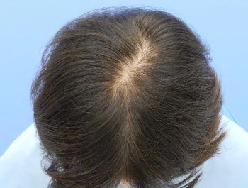 薄毛治療 発毛症例 55歳/頭頂部/初診時
