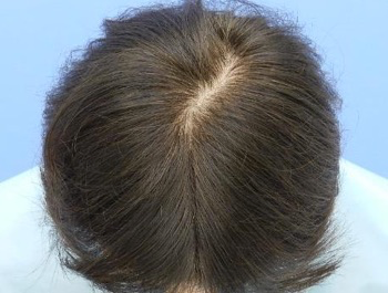 AGA治療例:55歳/頭頂部/薄毛歴4年/主婦/3ヶ月後