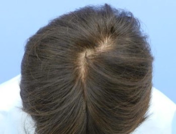 薄毛治療 発毛症例 55歳/頭頂部/8ヶ月後