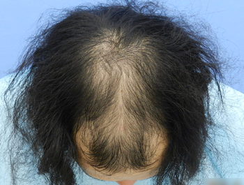 薄毛治療 発毛症例 24歳/MO型/初診時