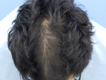 薄毛治療 発毛症例 24歳/MO型/7ヶ月後