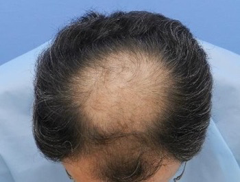 薄毛治療 発毛症例 51歳/O型/初診時