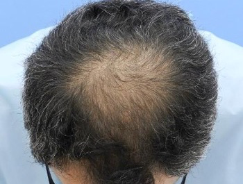 薄毛治療 発毛症例 51歳/O型/10ヶ月後