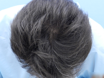 薄毛治療 発毛症例 56歳/O型/6ヶ月後