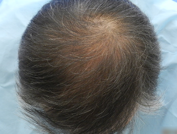 薄毛治療 発毛症例 55歳/O型/初診時