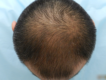 薄毛治療 発毛症例 48歳/MO型/9ヶ月後