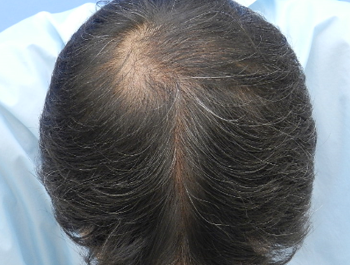薄毛治療 発毛症例 52歳/MO型/7ヶ月後