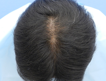 薄毛治療 発毛症例 39歳/O型/7ヶ月後