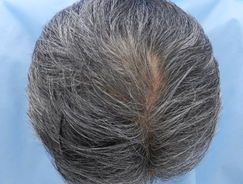 薄毛治療 発毛症例 49歳/O型/6ヶ月後