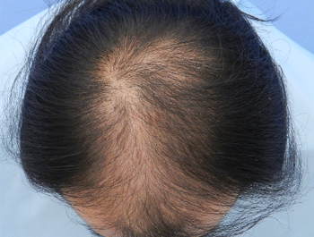 薄毛治療 発毛症例 40歳/MO型/初診時