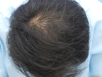薄毛治療 発毛症例 40歳/MO型/8ヶ月後