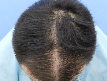 薄毛治療 発毛症例 28歳/M型/初診時