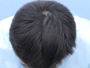 薄毛治療 発毛症例 28歳/M型/5ヶ月後